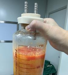 东台水动力吸脂手术要做多久？